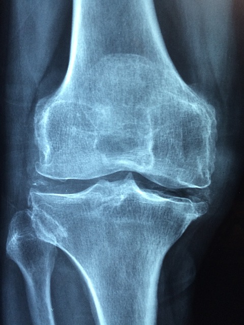 osteoporosis milpitas