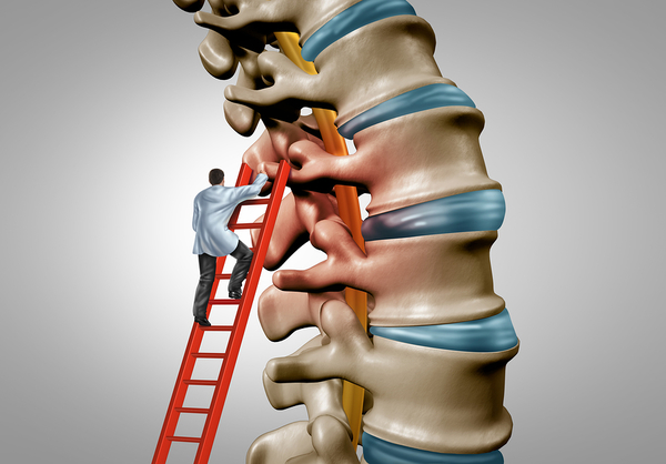 Spinal_Stenosis